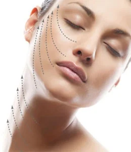How Long Does A PDO Thread Lift Last?