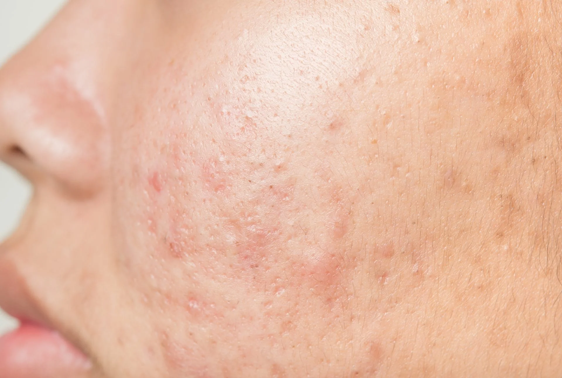 Truth About Acne