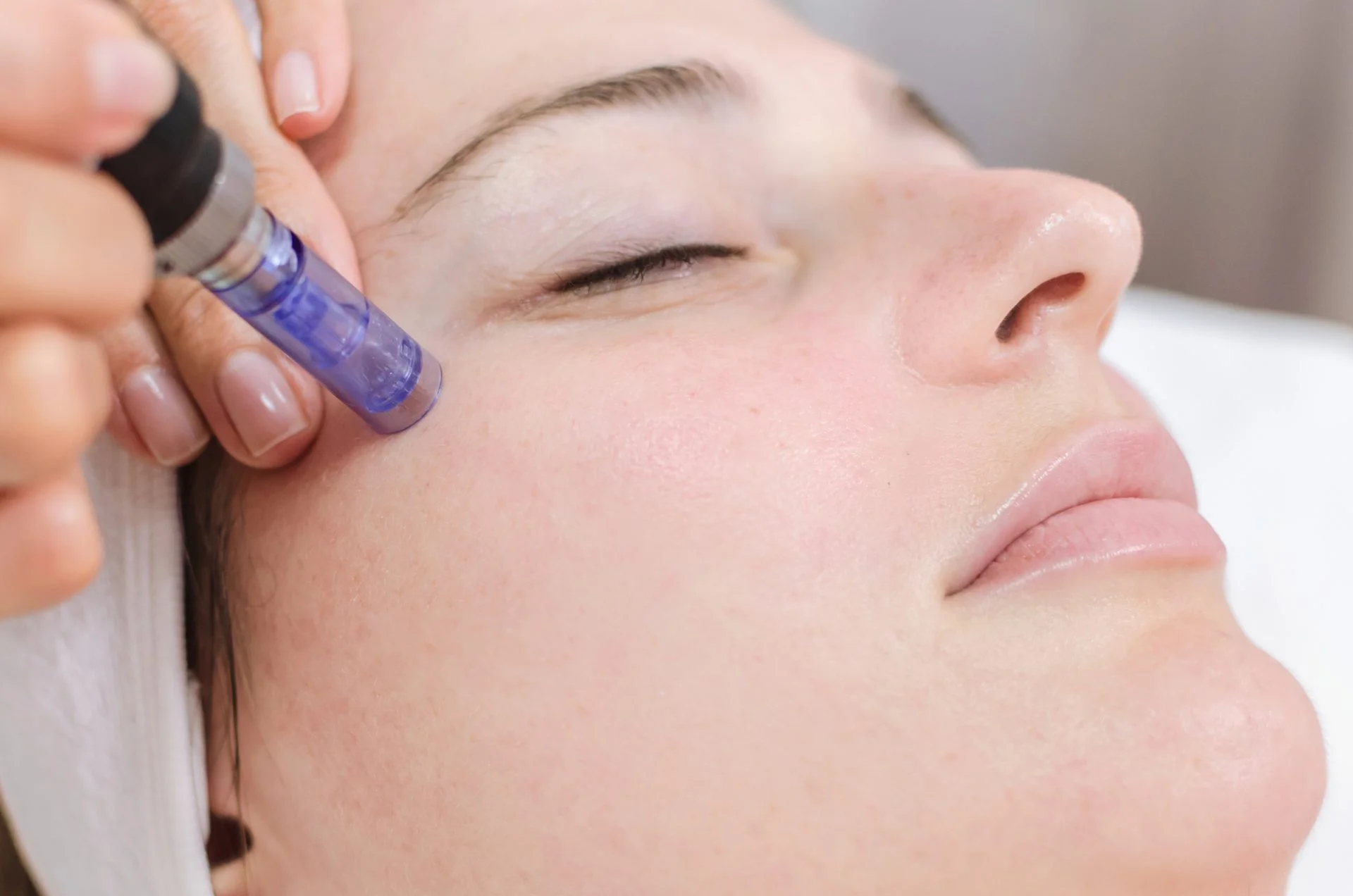 Microneedling Bristol — Stimulate Natural Skin Renewal for Smoother, Healthier Skin